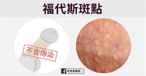 陰莖 一顆|包皮長一粒一粒東西？5 種「陰莖顆粒」可能成因解。